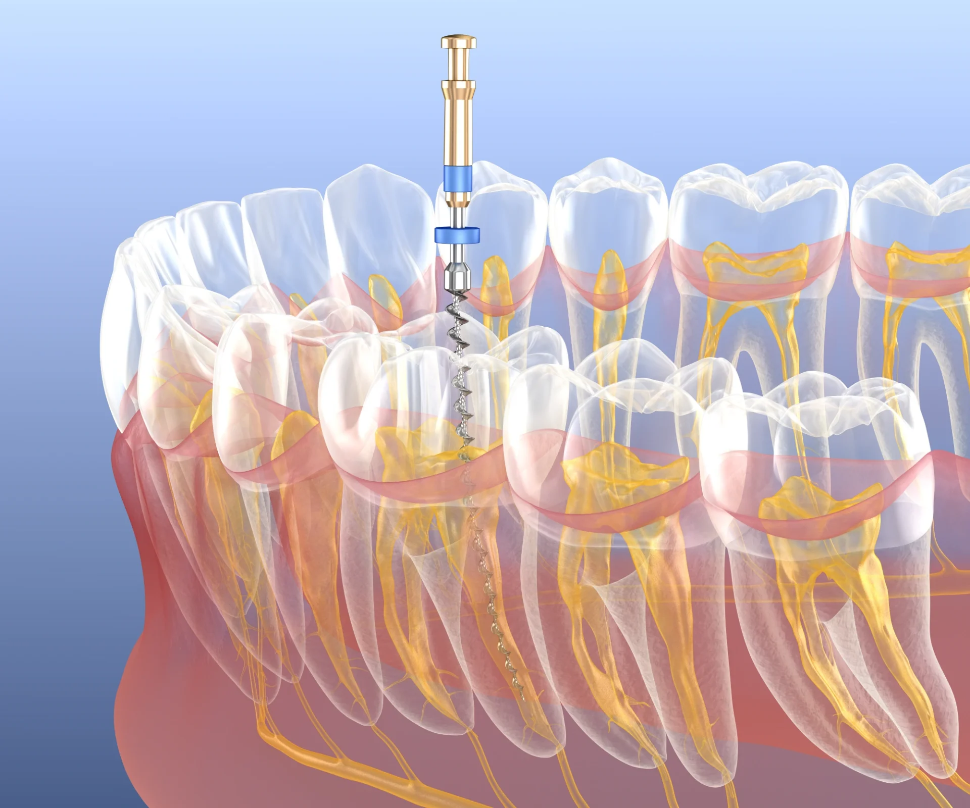 Dental root canal procedure illustration with tools.