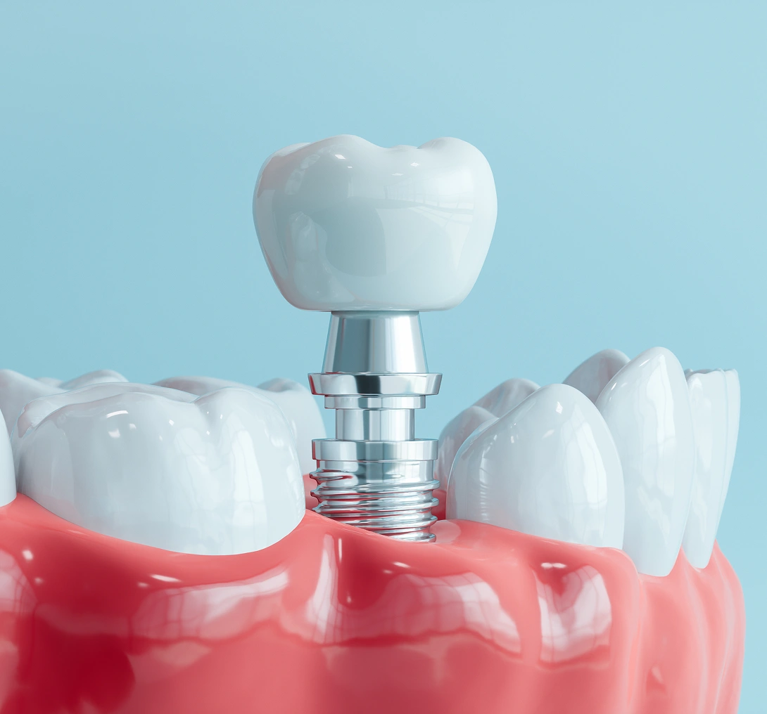 Dental implant model with crown and screw.