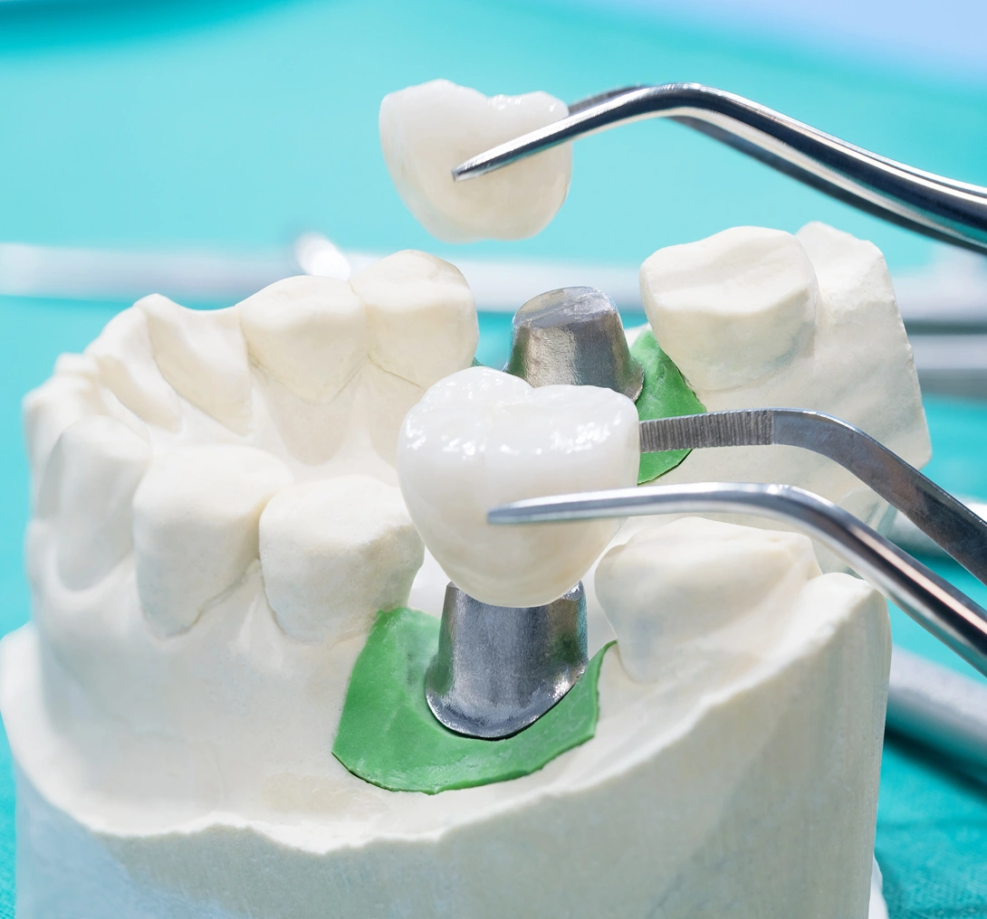 Dental crown placement on tooth model.