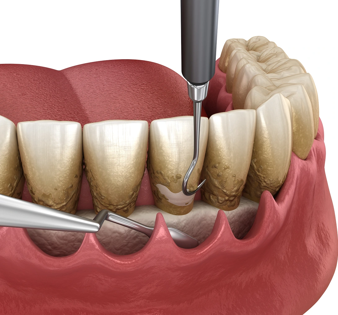 Dental cleaning with tartar removal tools illustration.
