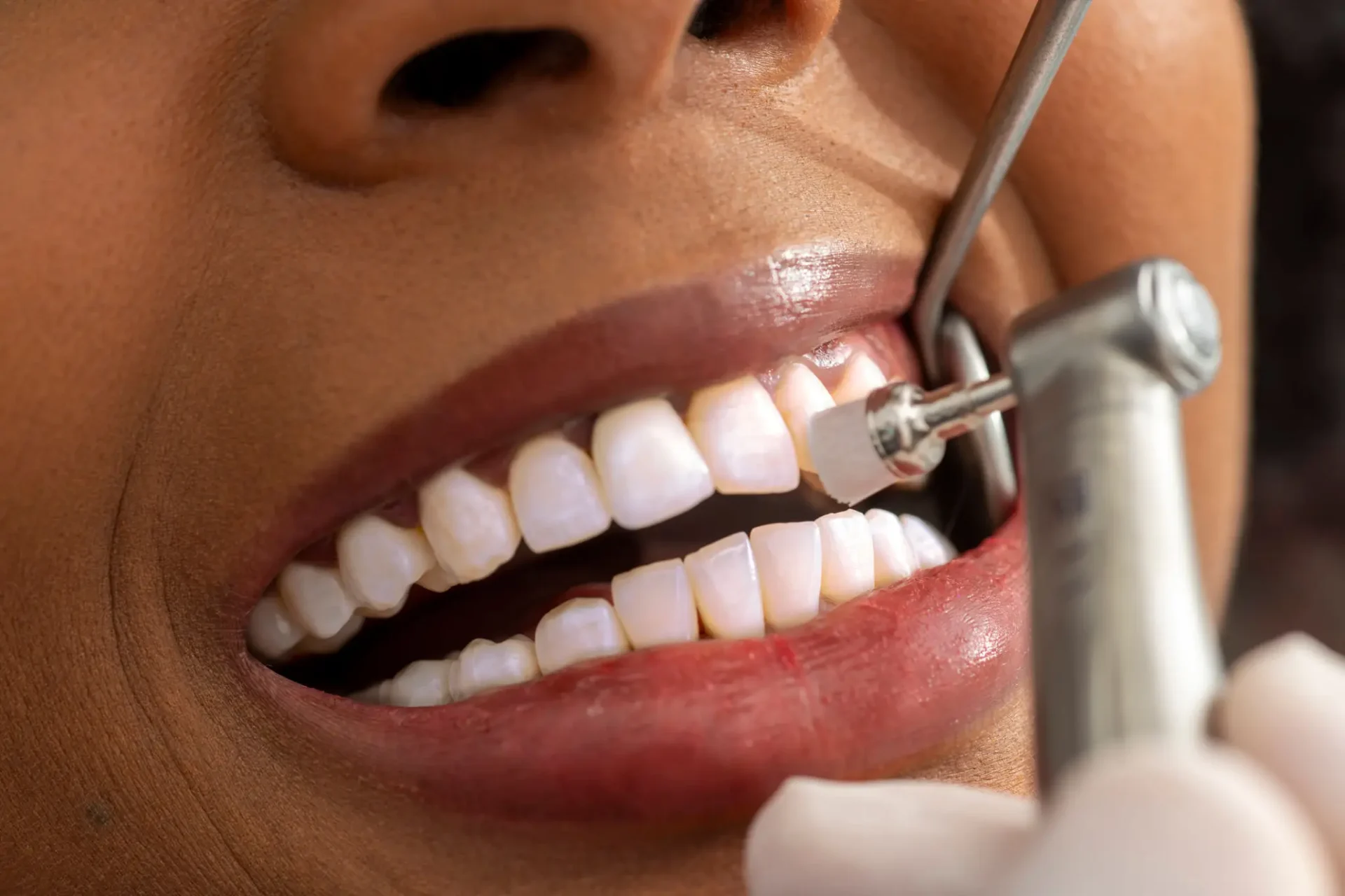 Dental check-up with polishing tool in mouth.
